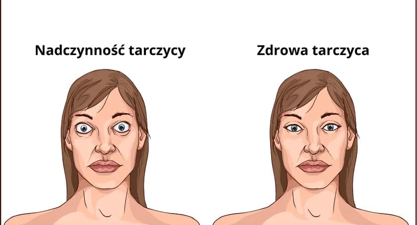 Objawy nadczynności tarczycy u osób starszych - jak je rozpoznać?