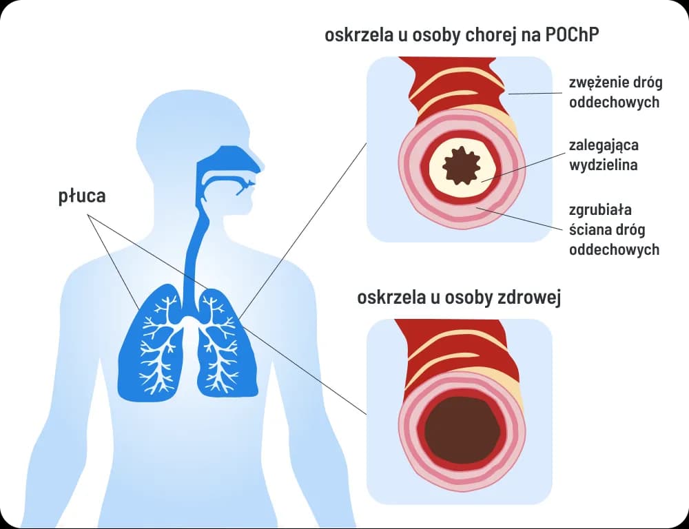 Czy POChP kwalifikuje do renty? Sprawdź, co musisz wiedzieć