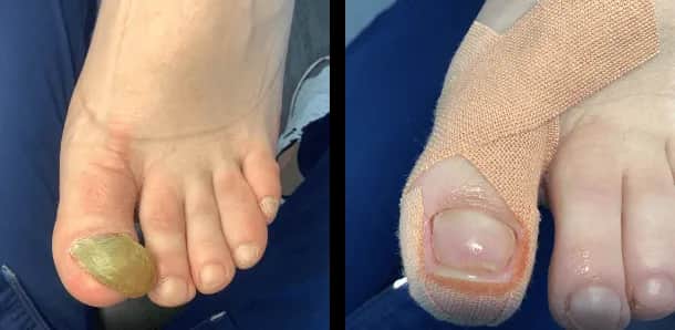 Jak zmiękczyć paznokcie u nóg u starszej osoby, by uniknąć bólu?