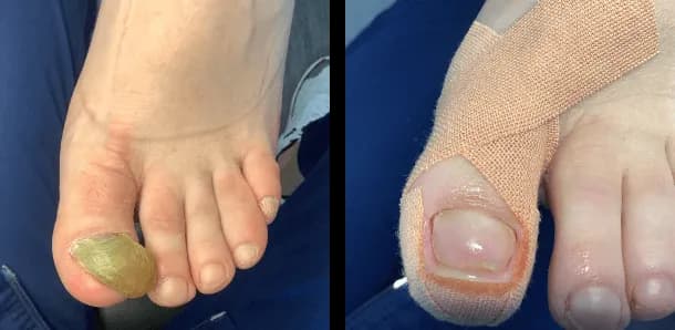 Jak zmiękczyć paznokcie u nóg u starszej osoby, by uniknąć bólu?