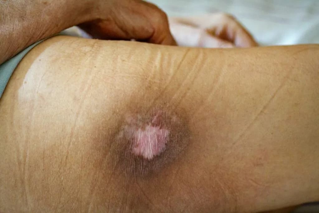 Skuteczne metody na odleżyny u starszej osoby – zapobieganie i leczenie